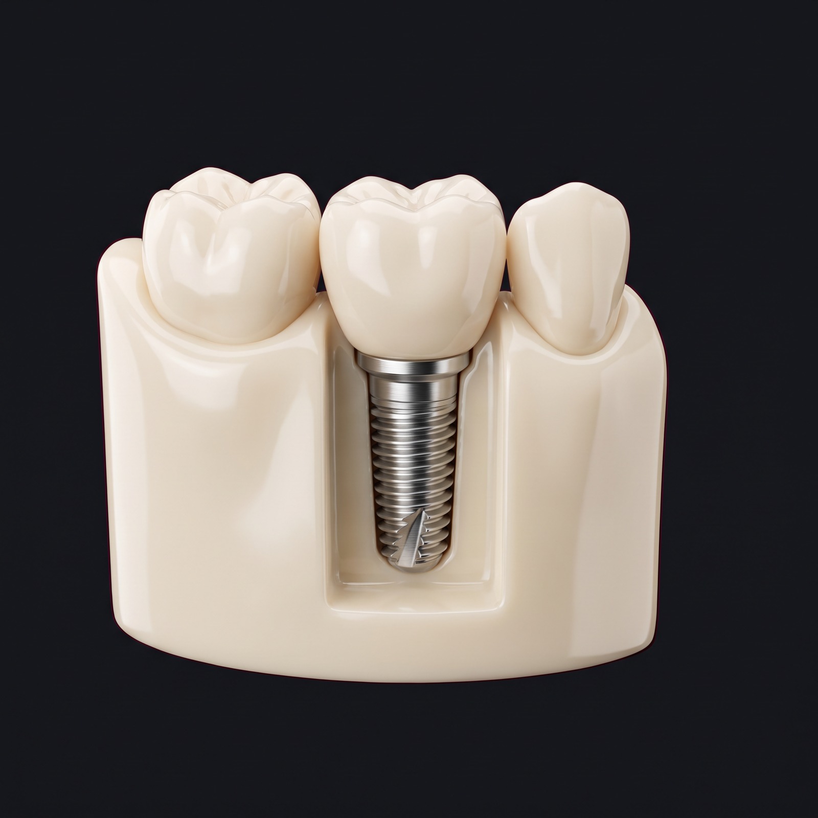 Modello illustrativo di un impianto dentale