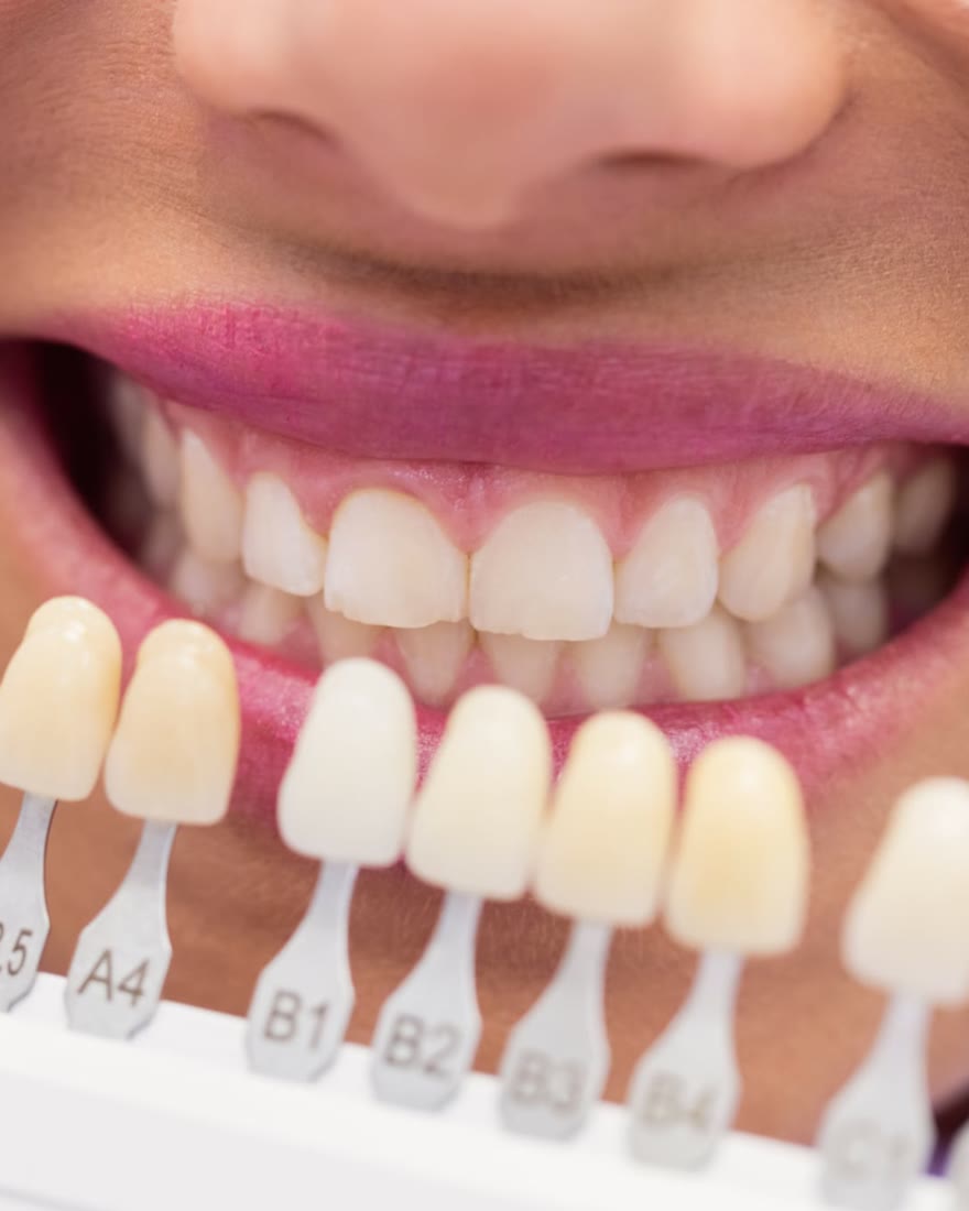 Sorriso con la scala dei colori dei denti per lo sbiancamento